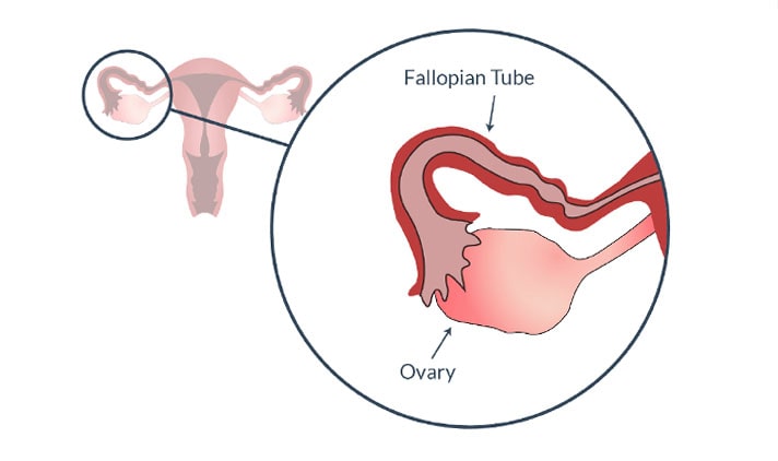 fallopian tube blocked causes