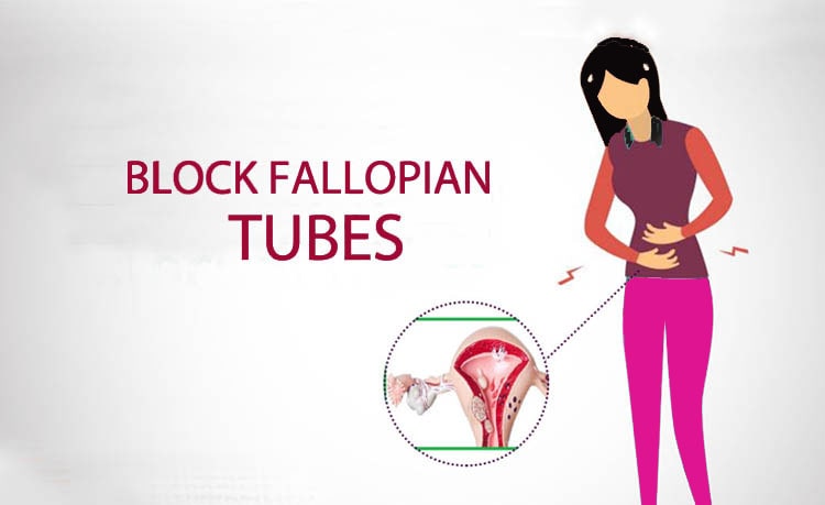 Fallopian tube block hone kelakshan
