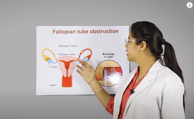 blocked fallopian tube