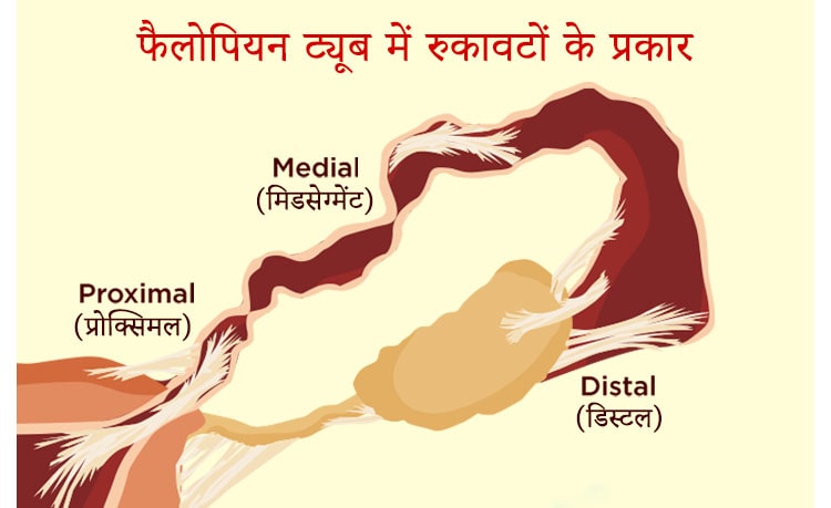 types of fallopian tube blockage