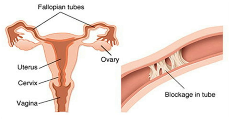 if you have fallopian tube blockage