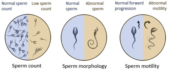 How to infertility  affect by azoospermia or nil sperm count