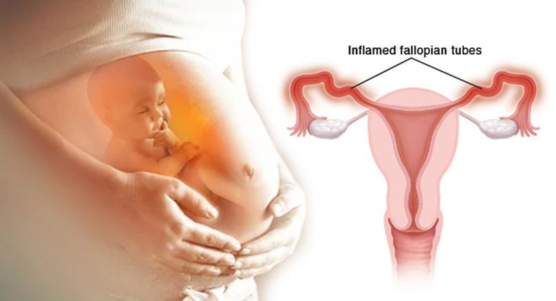 Fallopian Tube Blockage Treatment