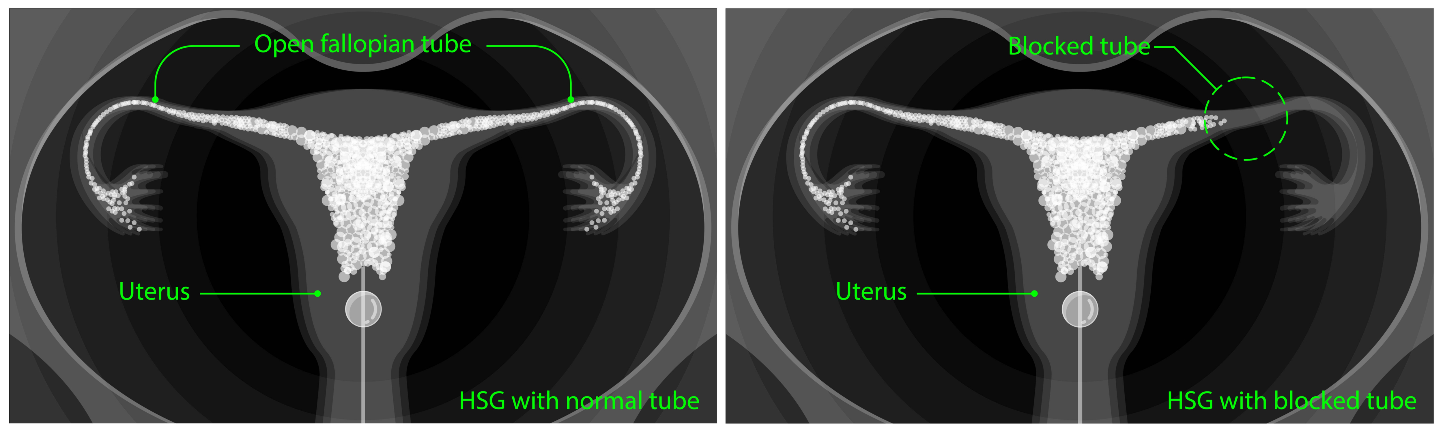 Procedures for infertility due to blocked fallopian tubes