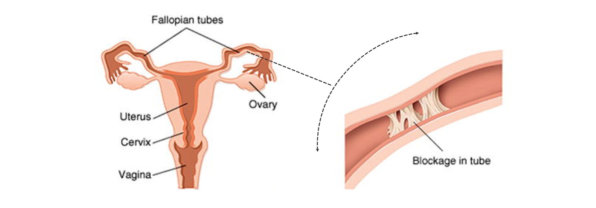 Natural treatment for fallopian (uterine) tube blockage