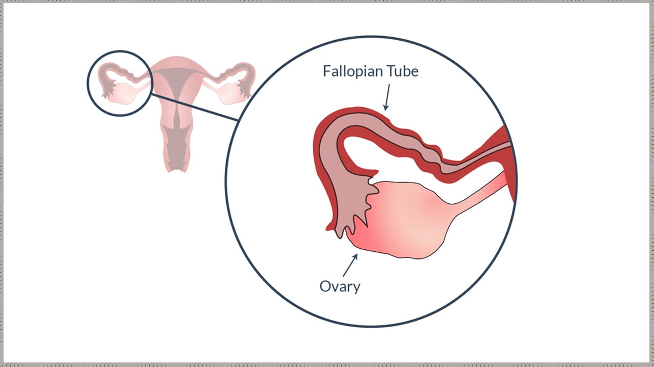 Blocked fallopian tube ka ayurvedic ilaj