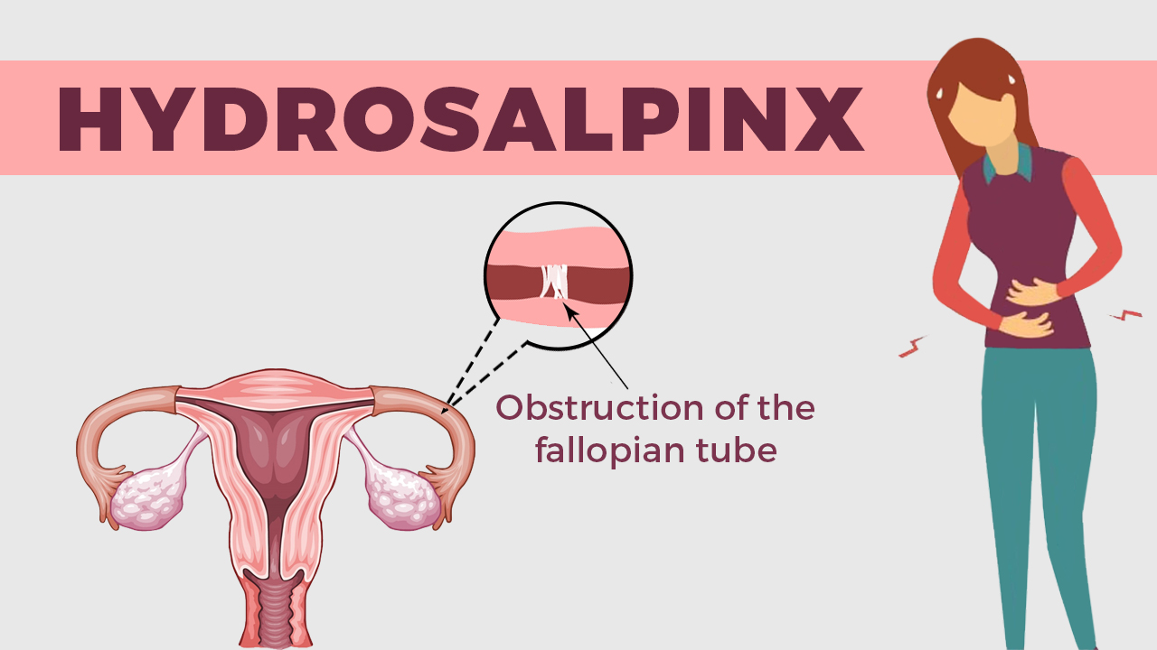 What to know about Hydrosalpinx