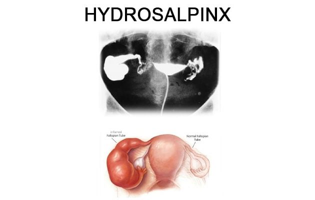 Ayurvedic treatment of Hydrosalpinx (blocked fallopian tube)