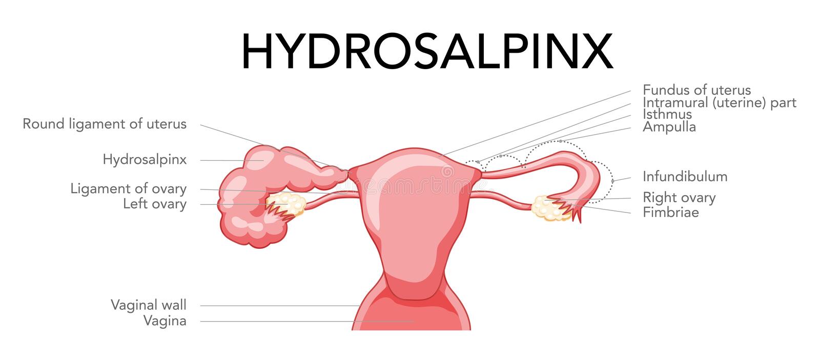 Hydrosalpinx: causes, symptoms and ayurvedic treatment-Aasha Ayurveda