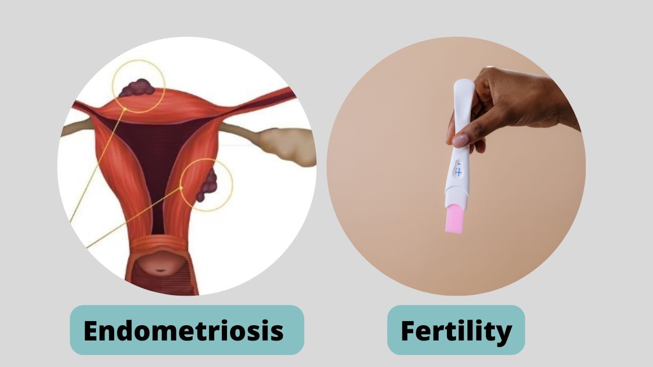 Endometriosis: symptoms, treatment and causes