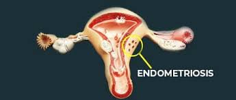 एंडोमेट्रियोसिस: लक्षण, कारण और उपचार- Endometriosis: Lakshan, Karan Aur Upchar