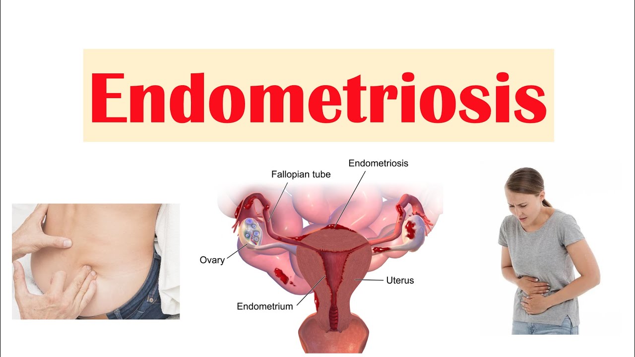 Endometriosis: diagnosis and treatment – Aasha Ayurveda