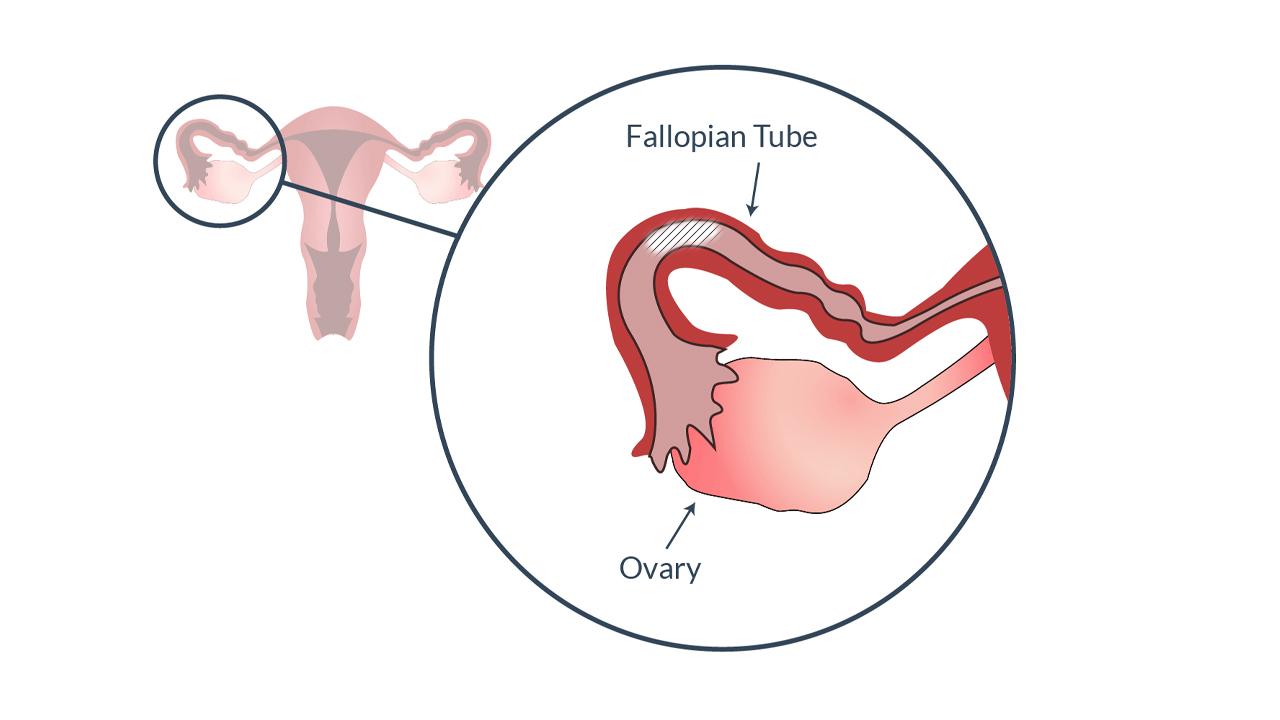 Ayurvedic Clinic for Opening Fallopian Tubes—Aasha Ayurveda