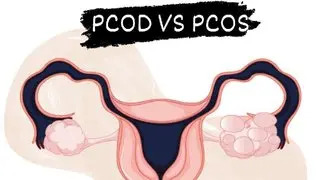 PCOD and PCOS: differences, causes, symptoms, and ayurvedic treatment
