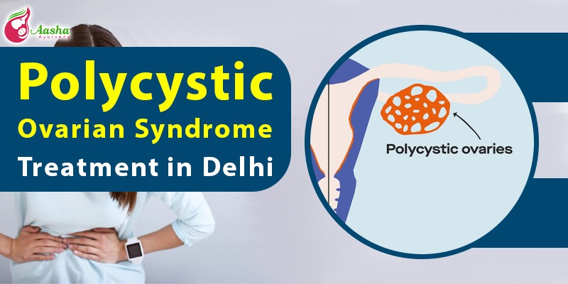 Polycystic Ovarian Syndrome Treatment in Delhi 