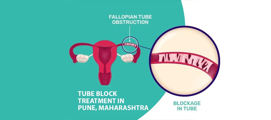 Tube Block Treatment in Pune - Infertility Doctor in Pune