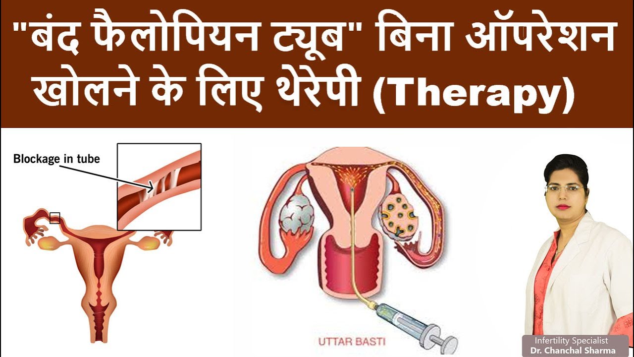 All about Fallopian Tube Blockage Treatment in Hindi - फैलोपियन ट्यूब में ब्लॉकेज की पूरी जानकारी